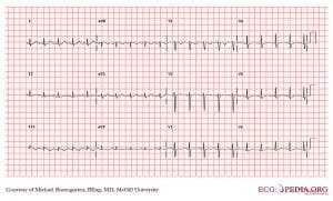 E0007081 CardioNetworks ECGpedia