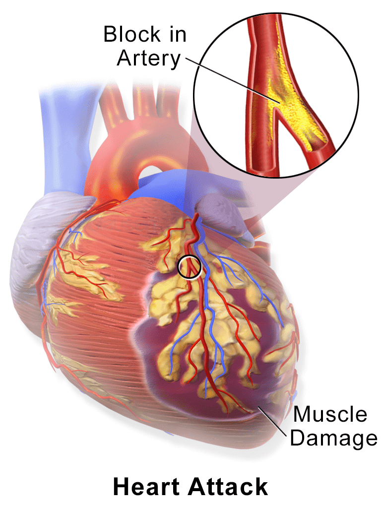 Paro Cardiaco Súbito