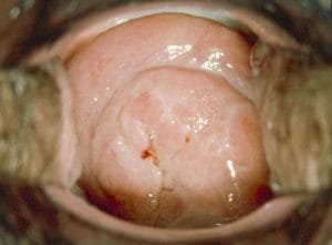 Diethylstilbestrol des cervix 6