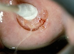 Diethystilbestrol des cervix