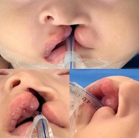 ¿Cómo se trata el labio leporino y paladar hendido?