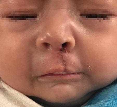 cirugia labio lepo 2.jpg3 .jpg4