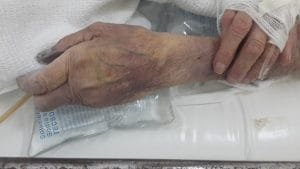 Cianosis periférica 