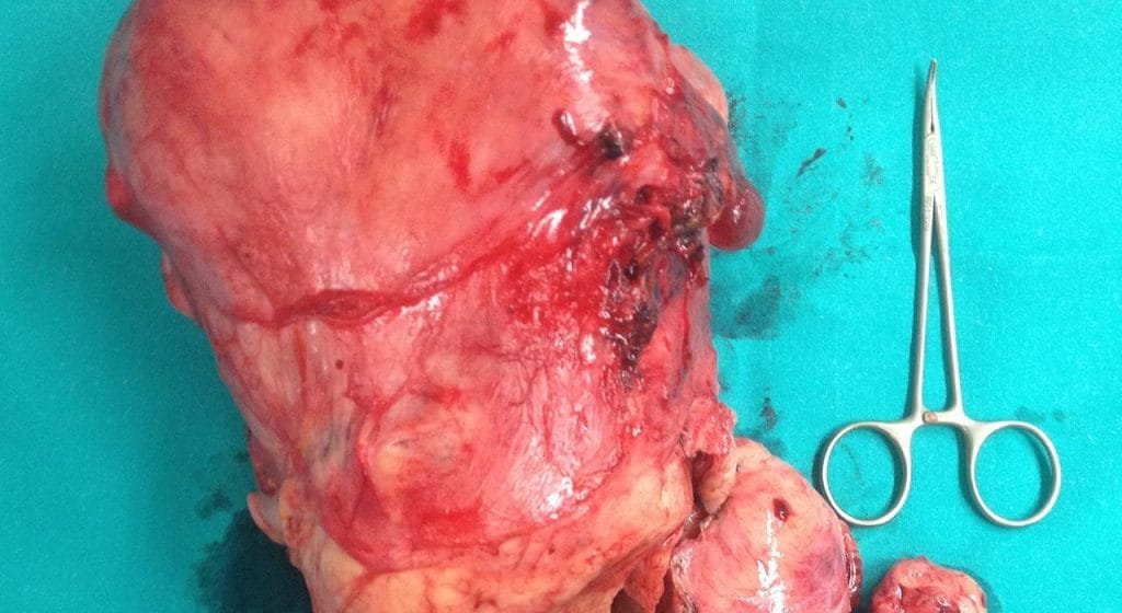 Sarcoma uterino
