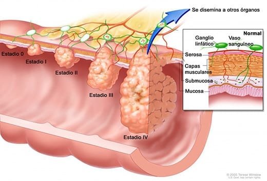 Síntomas de cáncer metastásico