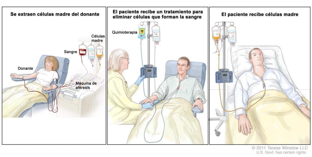 stem cell transplant enlarge esp. v300287097