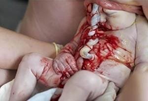 Parto de Nalgas 12 Parto de Nalgas