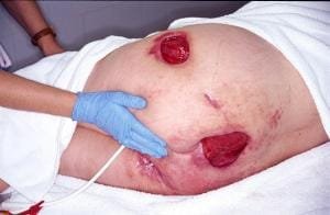 Escalas de Úlceras por presión 4 Escalas de Úlceras por presión