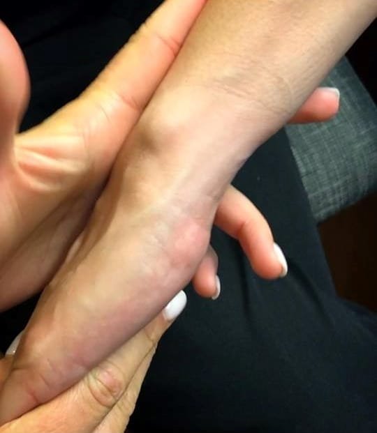 Venoclisis perfecta 3 Venoclisis perfecta