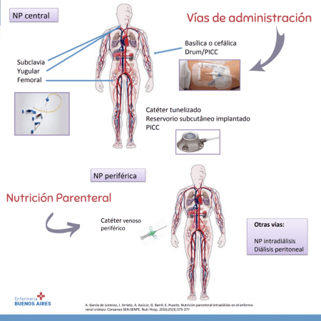 ¿Qué es la Nutrición Parenteral?