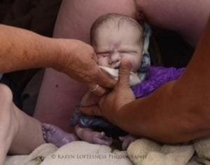 Parto de Nalgas 10 Parto de Nalgas