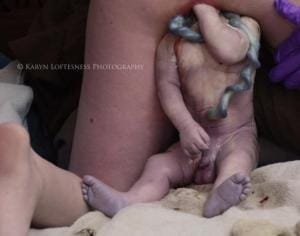 Parto de Nalgas 8 Parto de Nalgas