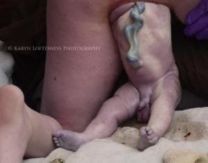 Parto de Nalgas 6 Parto de Nalgas