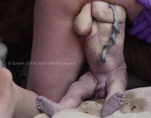 Parto de Nalgas 7 Parto de Nalgas