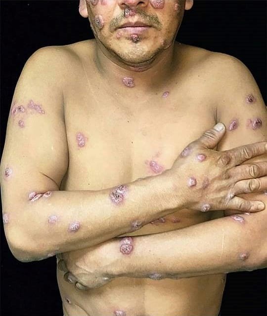 blastomicosis cutanea diseminada1