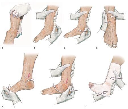 Luxo fractura abierta del tobillo 4 Luxo fractura abierta del tobillo