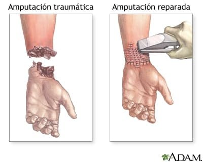 ¿Qué es una amputación? 6 ¿Qué es una amputación?