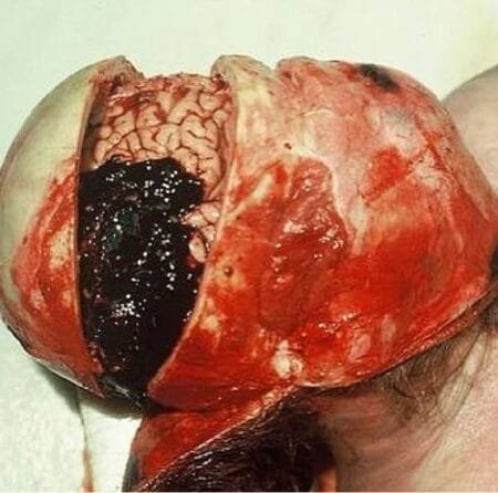 Hematoma subdural
