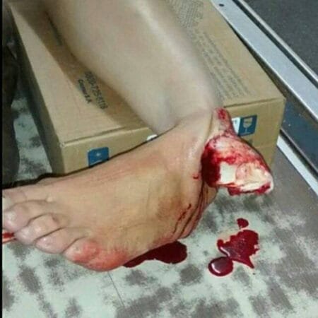 Luxo fractura abierta del tobillo 2 Luxofractura abierta del tobillo