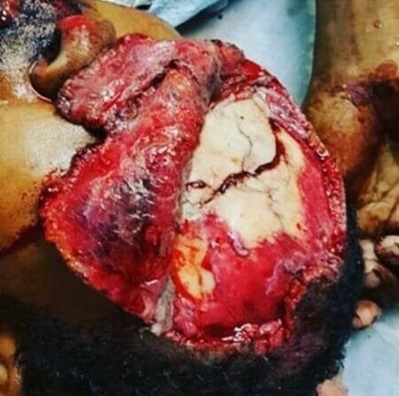 Accidente en moto 6 Accidente en moto