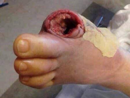 ¿Qué es una amputación? 2 ¿Qué es una amputación?