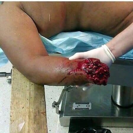 ¿Qué es una amputación? 4 ¿Qué es una amputación?