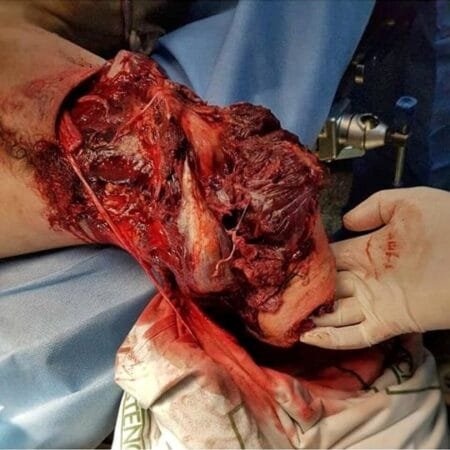 ¿Qué es una amputación? 3 ¿Qué es una amputación?