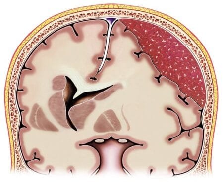 Hematoma subdural