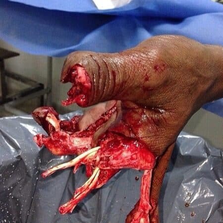 Lesión por explosión de fuegos artificiales 3 Lesión por explosión de fuegos artificiales