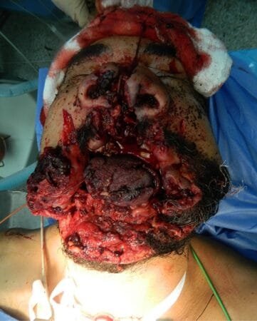 Herida por arma de fuego 4 Herida por arma de fuego