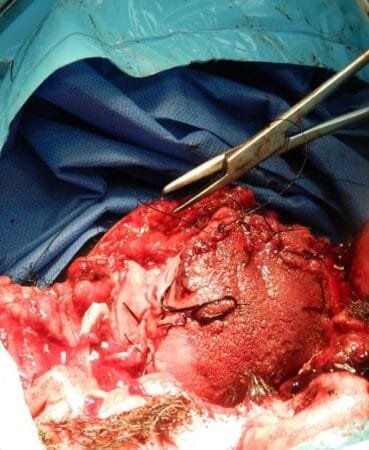 Herida por arma de fuego 2 Herida por arma de fuego