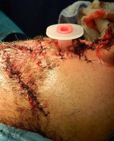 Herida por arma de fuego 3 Herida por arma de fuego