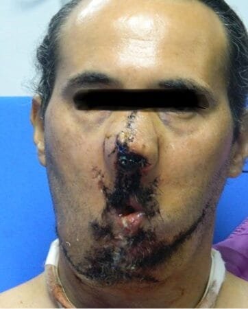 Herida por arma de fuego 9 herida por arma de fuego 7