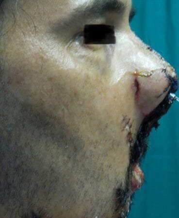 Herida por arma de fuego 10 Herida por arma de fuego