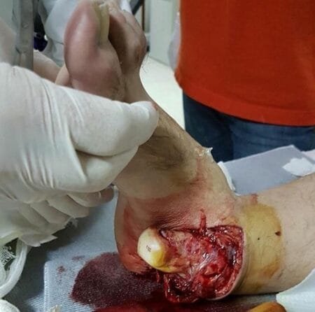 Luxo fractura abierta del tobillo 3 Luxo fractura abierta del tobillo