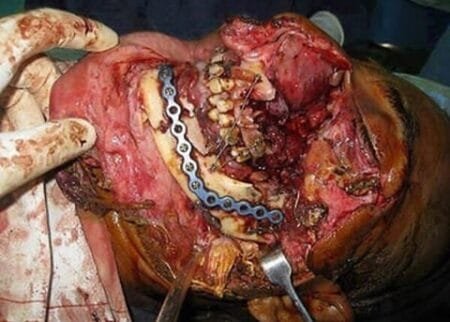 Reconstrucción mandibular por lesión de agente químico