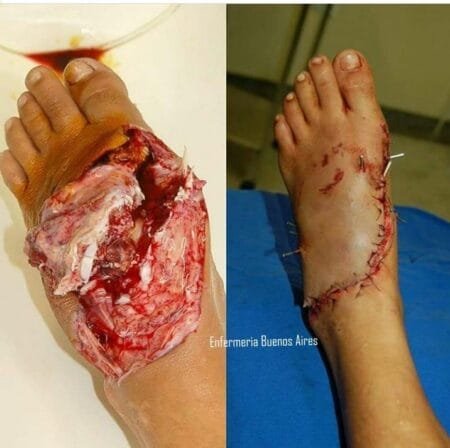 Traumatismo por aplastamiento 3 Traumatismo por aplastamiento