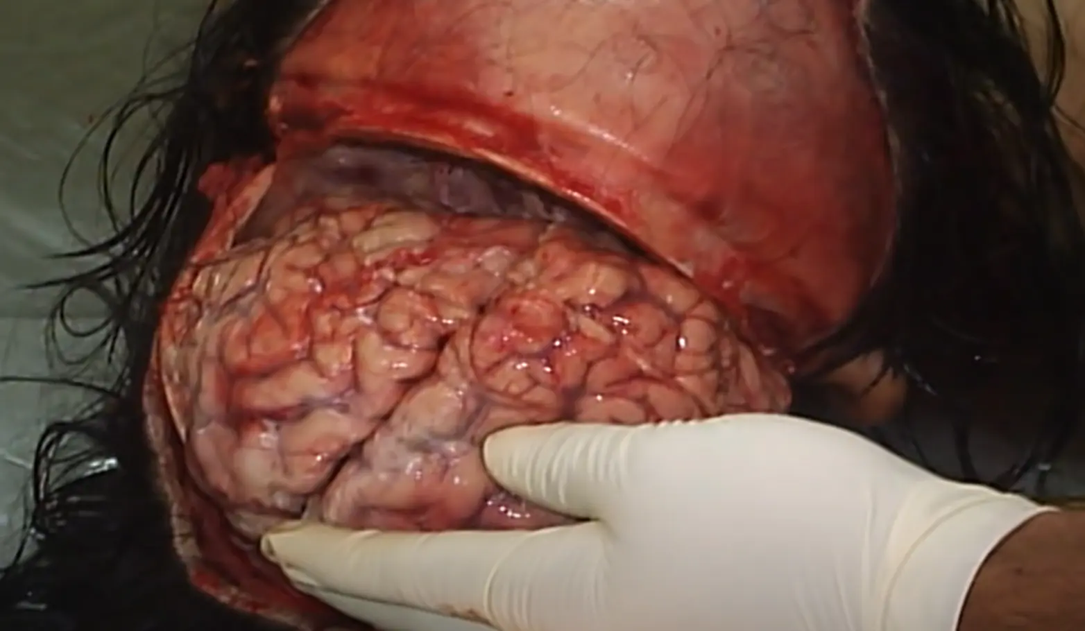 Autopsia por hemorragia cerebral