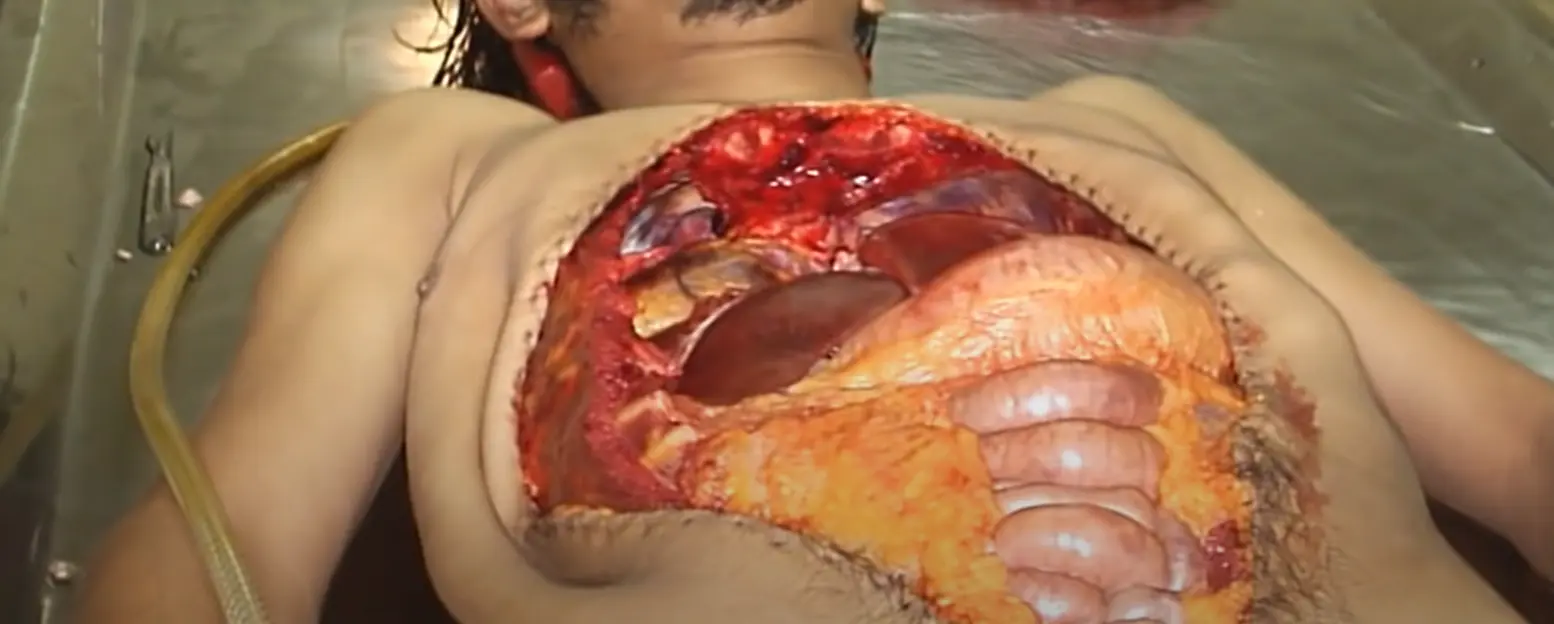 Autopsia por hemorragia cerebral